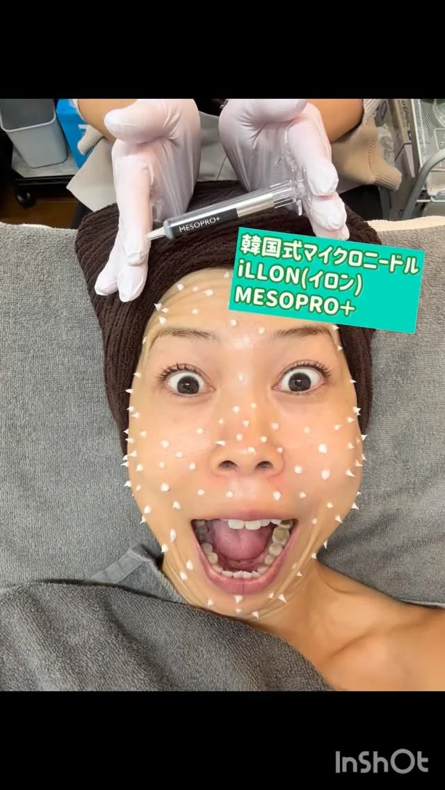 パワフルまどかの潜入捜査‼️
韓国式美容が松江で⁉️
-salon noix(サロン ノワ)編-

以前ハーブピーリングでお邪魔した
サロン ノワさんに新たなメニューが加わった😳
ということで、早速行ってみました💨

詳細は動画で‼️
チクチク感は翌日まであったけど、
毛穴がキュッとなり、
肌質がツヤっとなったのが自分でも分かり…😳

こないだも
また行きたくなったけど、
今回のメニューでも、、、また行きたい😆

韓国美容を松江で味わって見たい方
おすすめ👍✨

荒木まどかの投稿を見た‼️
で、問合せ、予約をすると
お得な特典があるらしい😏

予約は直接
@salon_noix さんにご連絡を😊

#山陰
#島根
#松江
#松江美容 
#松江サロン 
#松江エステ 
#ハーブピーリング 
#韓国美容 
#マイクロニードル 
#荒木まどか 
#ローカルタレント 
#パワフルmc 
#ショート女子 
#ハイトーンカラー
#ハーブテント 
#勝手に 
#pr